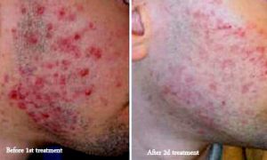 before and after acne